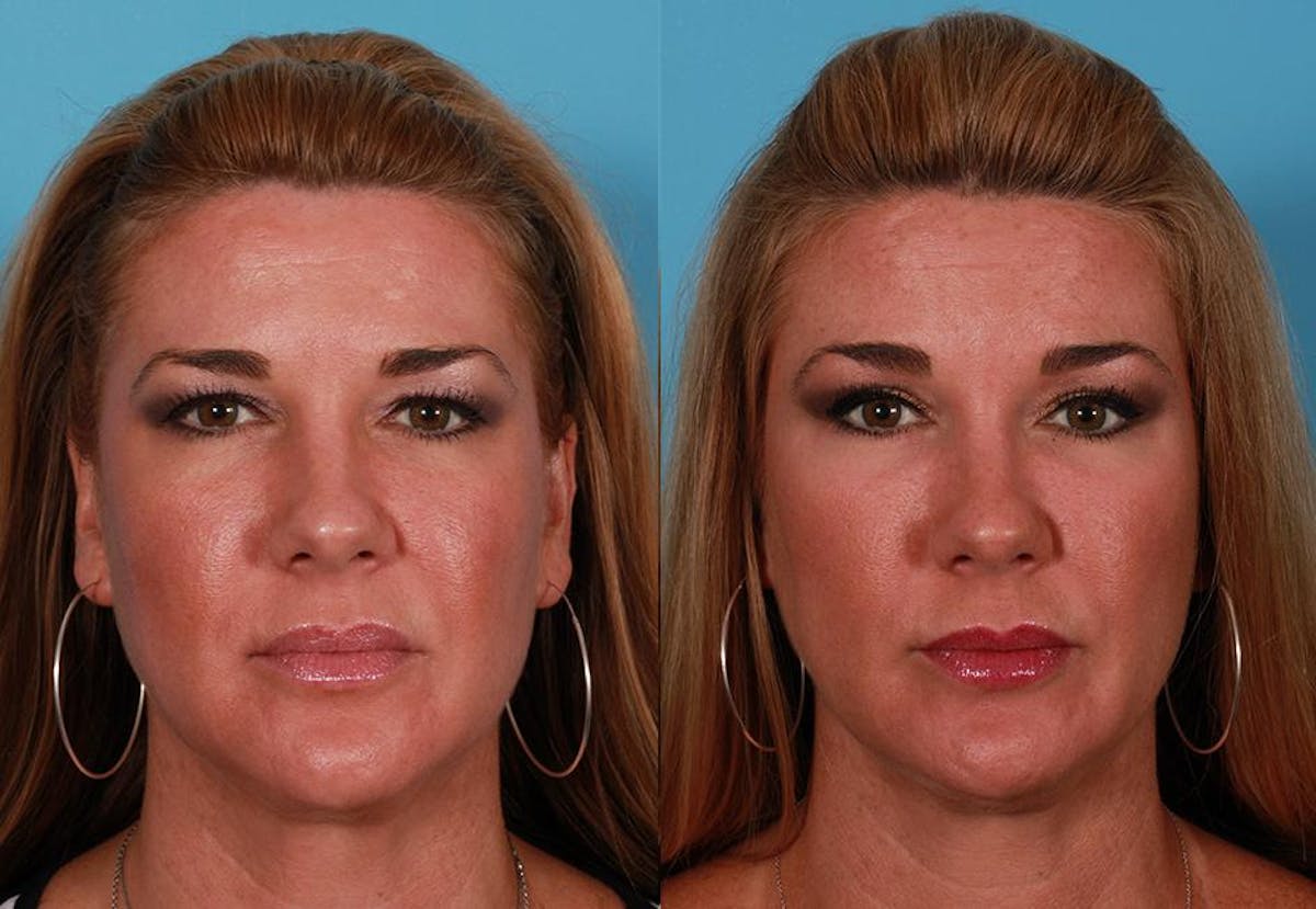 Endoscoplic Browlift Before & After Gallery - Patient 230833 - Image 1