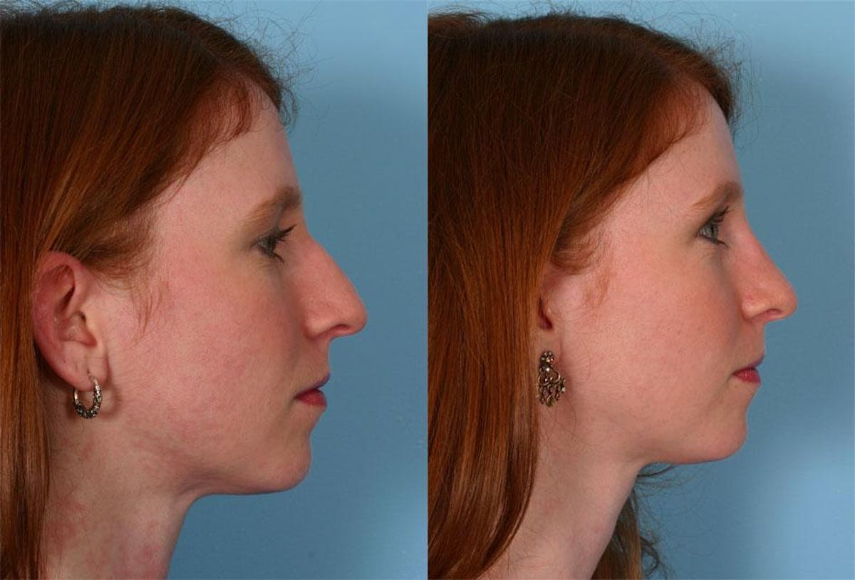 Rhinoplasty Before & After Gallery - Patient 100922 - Image 2
