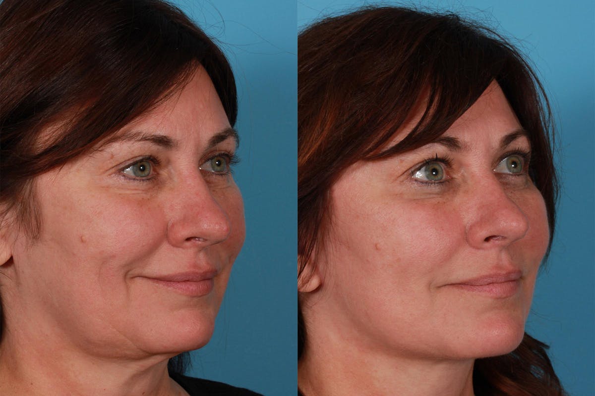 Limited Incision Facelift Before & After Gallery - Patient 218803 - Image 2