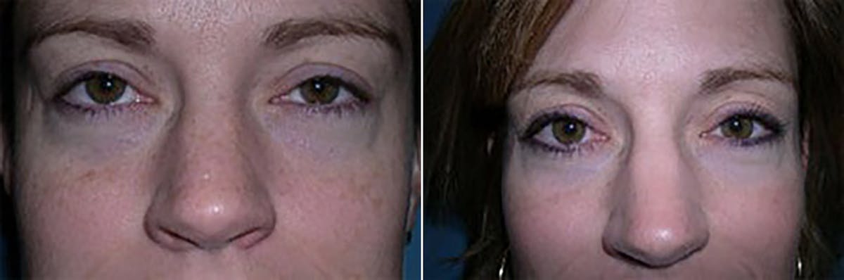 Eyelid Surgery (Blepharoplasty) Before & After Gallery - Patient 102441 - Image 3