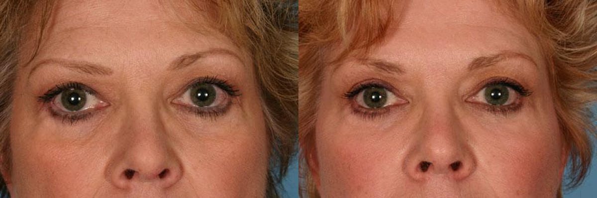 Facial Fat Transfer Before & After Gallery - Patient 408084 - Image 4