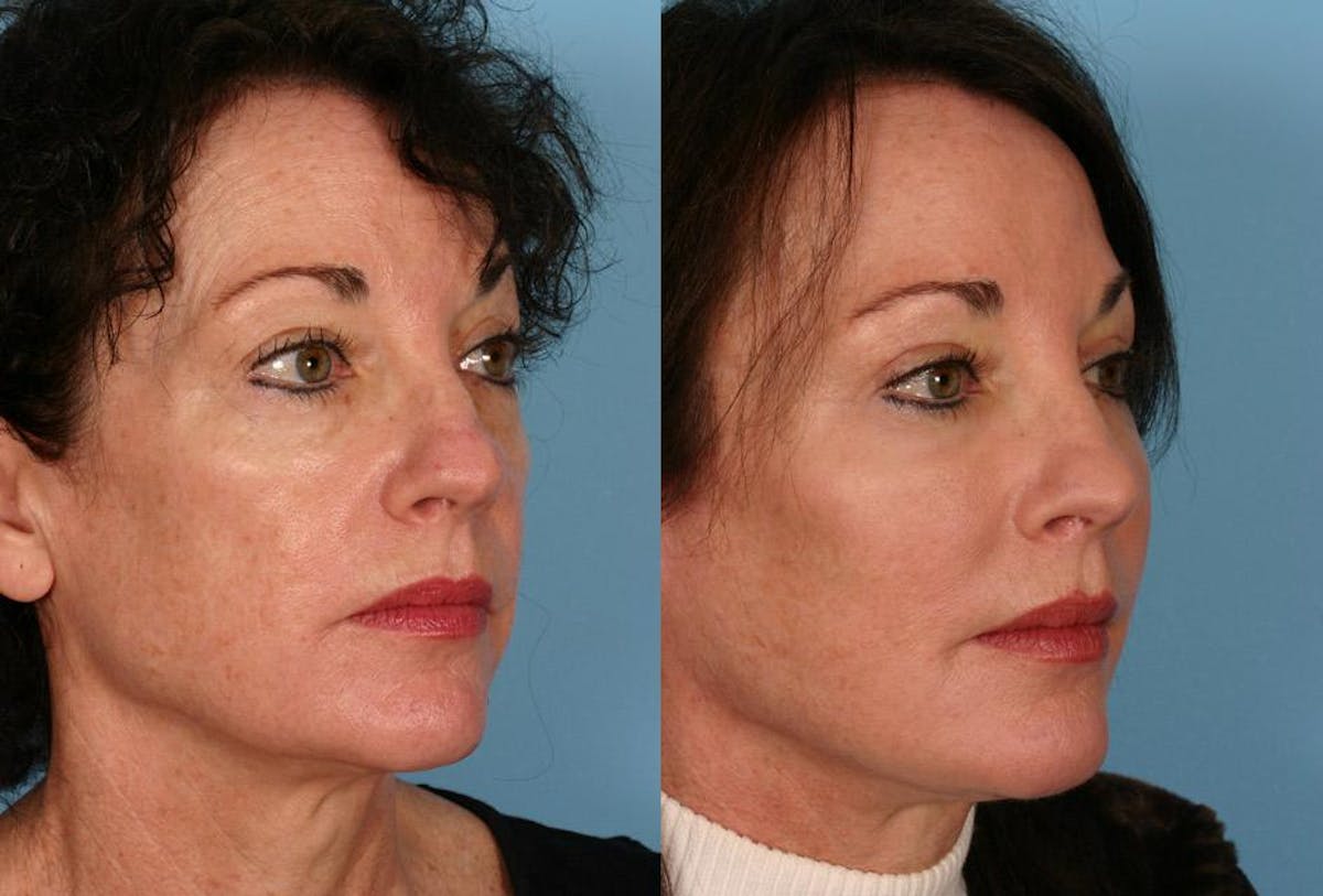 Facelift Before & After Gallery - Patient 330322 - Image 2