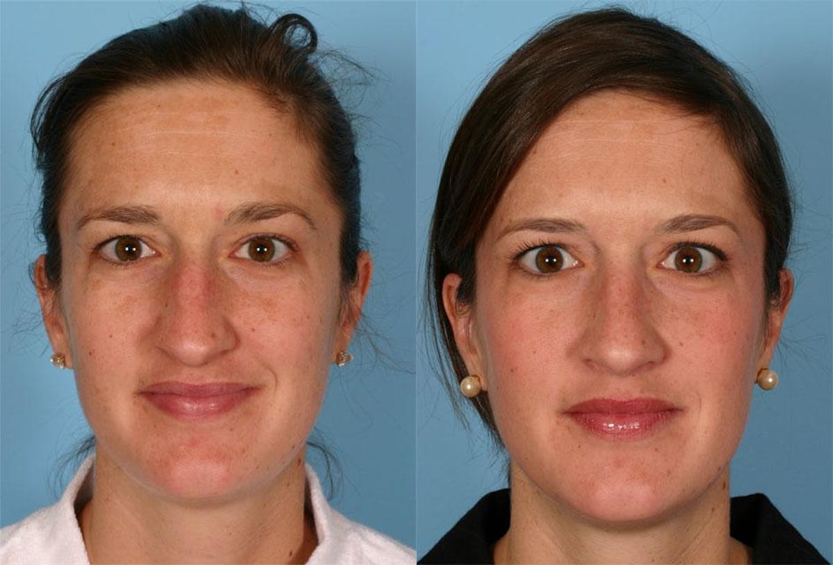 Rhinoplasty Before & After Gallery - Patient 357531 - Image 1