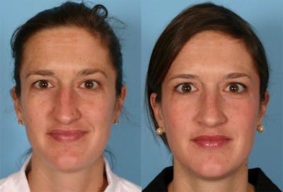 Rhinoplasty Before & After Gallery - Patient 357531 - Image 1