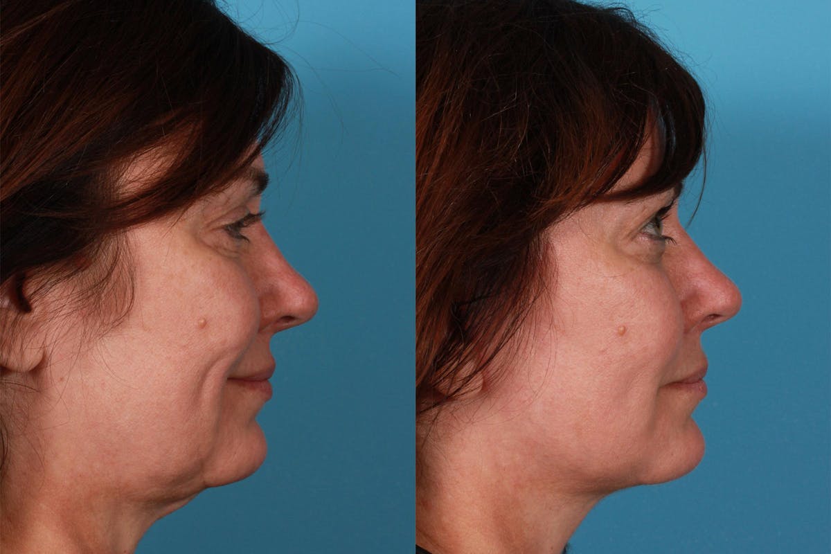 Limited Incision Facelift Before & After Gallery - Patient 218803 - Image 3