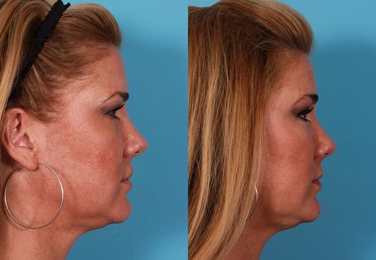 Endoscoplic Browlift Before & After Gallery - Patient 230833 - Image 3