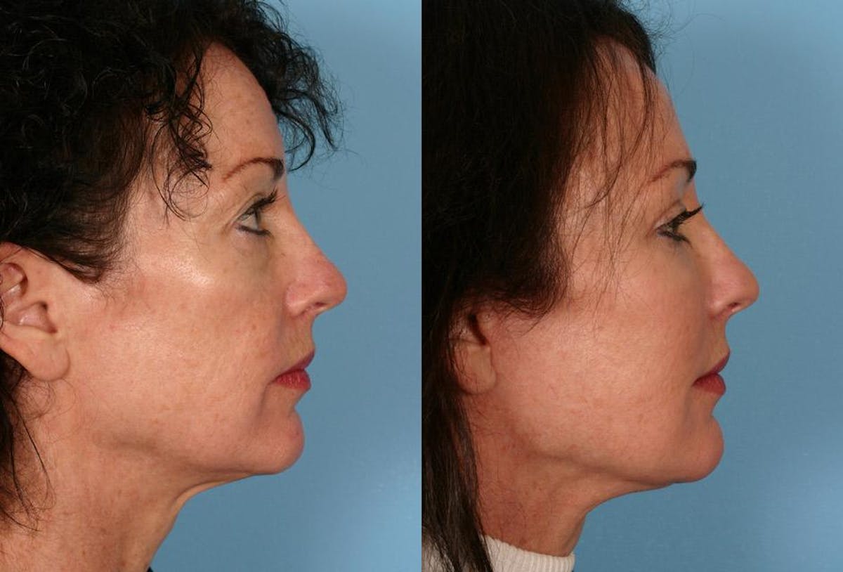 Facelift Before & After Gallery - Patient 330322 - Image 3