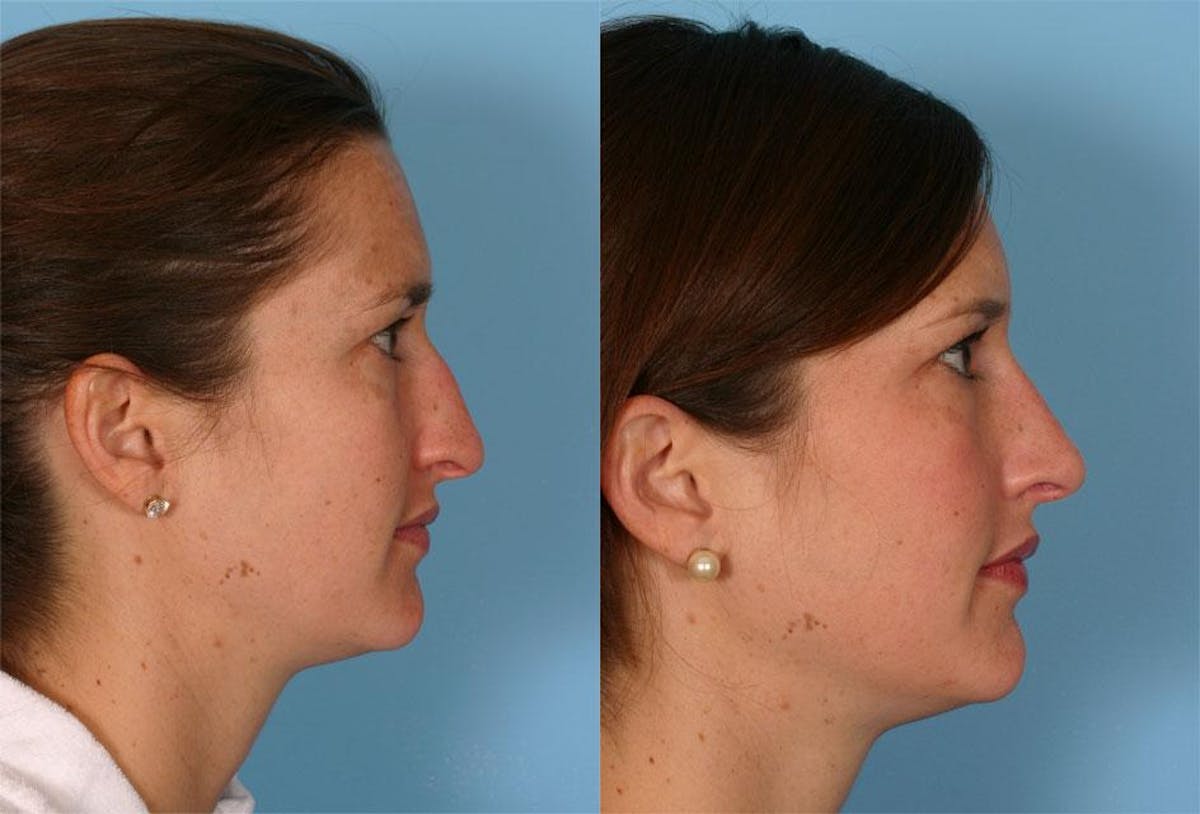 Rhinoplasty Before & After Gallery - Patient 357531 - Image 2