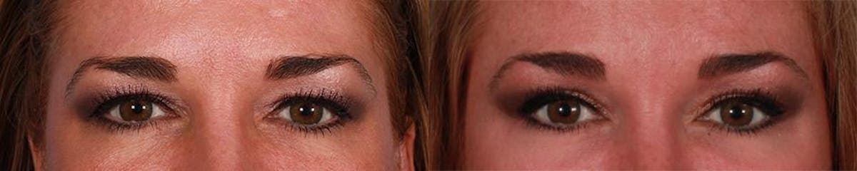 Endoscoplic Browlift Before & After Gallery - Patient 230833 - Image 4