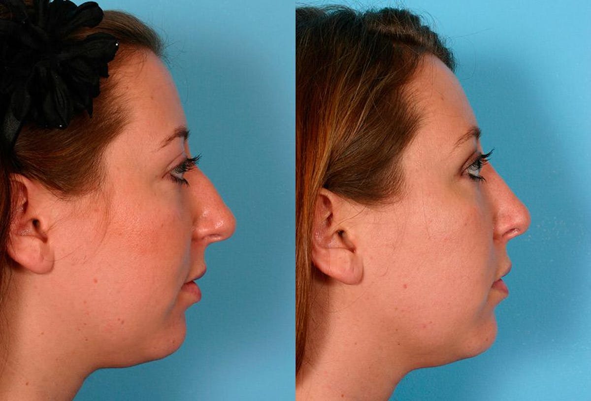 Nasal Obstruction Before & After Gallery - Patient 180789 - Image 2