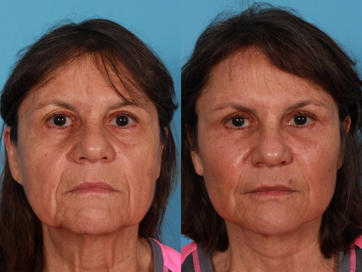 Limited Incision Facelift Before & After Gallery - Patient 347330 - Image 1