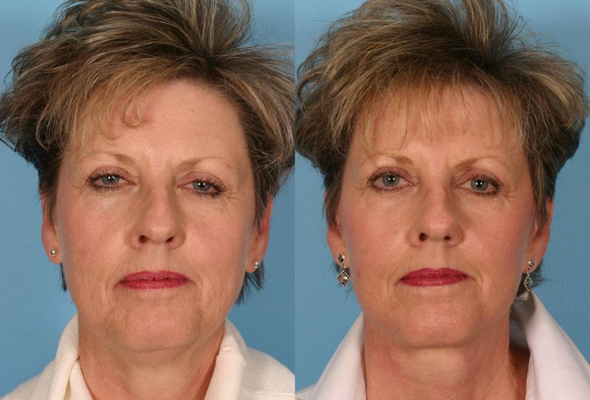 Facelift Before & After Gallery - Patient 329344 - Image 1
