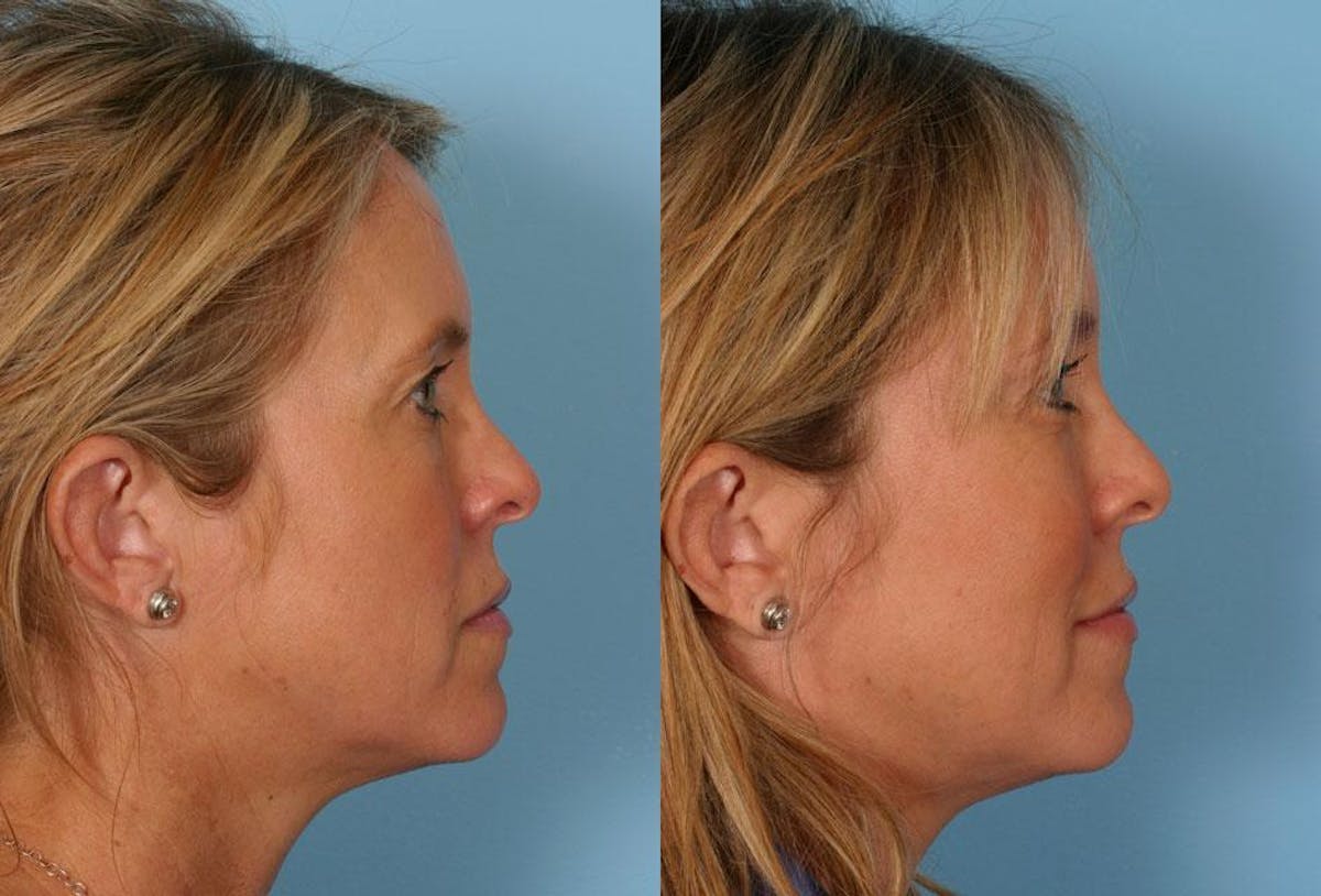 Facial Fat Transfer Before & After Gallery - Patient 137553 - Image 3