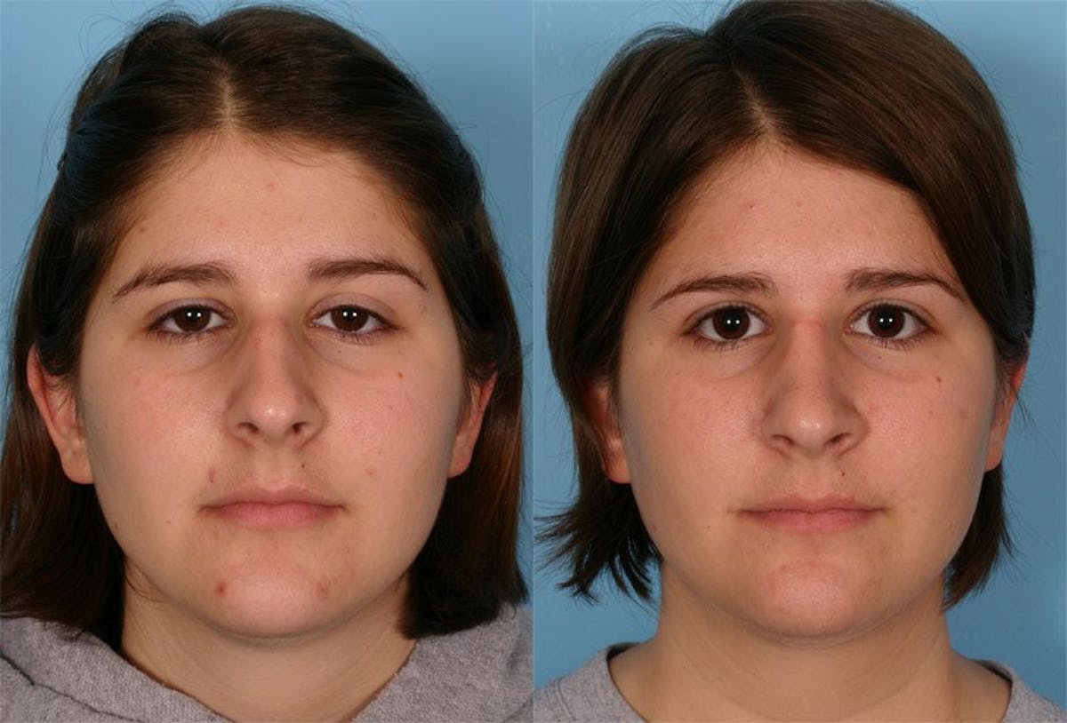 Rhinoplasty Before & After Gallery - Patient 341682 - Image 1