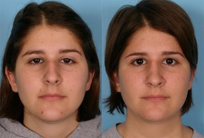 Rhinoplasty Before & After Gallery - Patient 341682 - Image 1