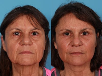 Endoscoplic Browlift Before & After Gallery - Patient 416183 - Image 1