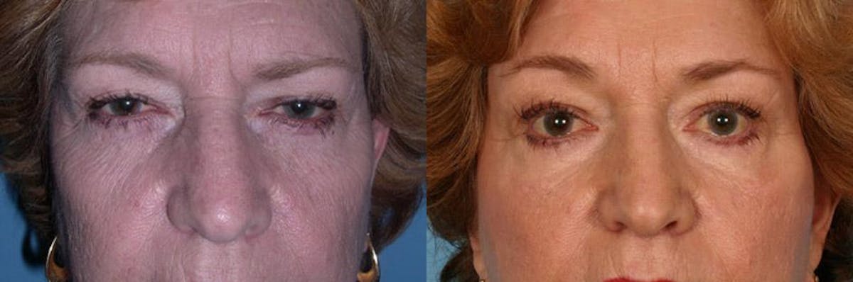 Eyelid Surgery (Blepharoplasty) Before & After Gallery - Patient 304875 - Image 3