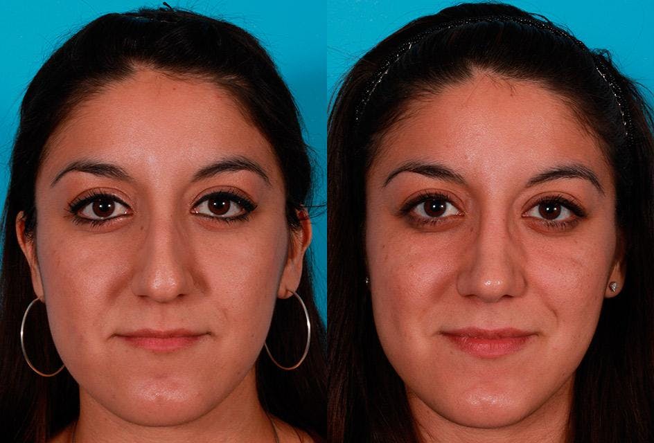 Nasal Obstruction Before & After Gallery - Patient 303066 - Image 1