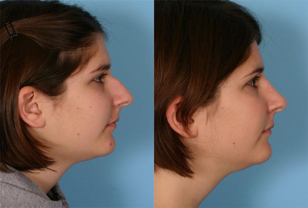 Rhinoplasty Before & After Gallery - Patient 341682 - Image 2