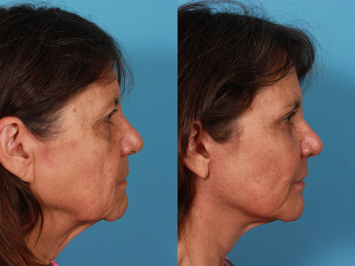 Limited Incision Facelift Before & After Gallery - Patient 347330 - Image 2