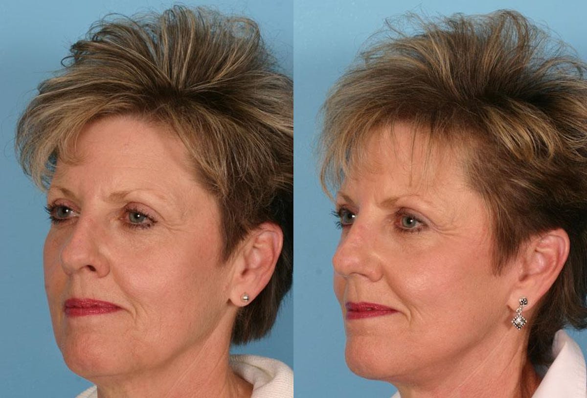 Facelift Before & After Gallery - Patient 329344 - Image 2