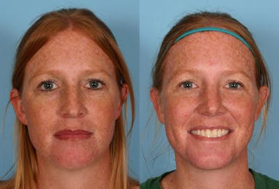 Rhinoplasty Before & After Gallery - Patient 280823 - Image 1