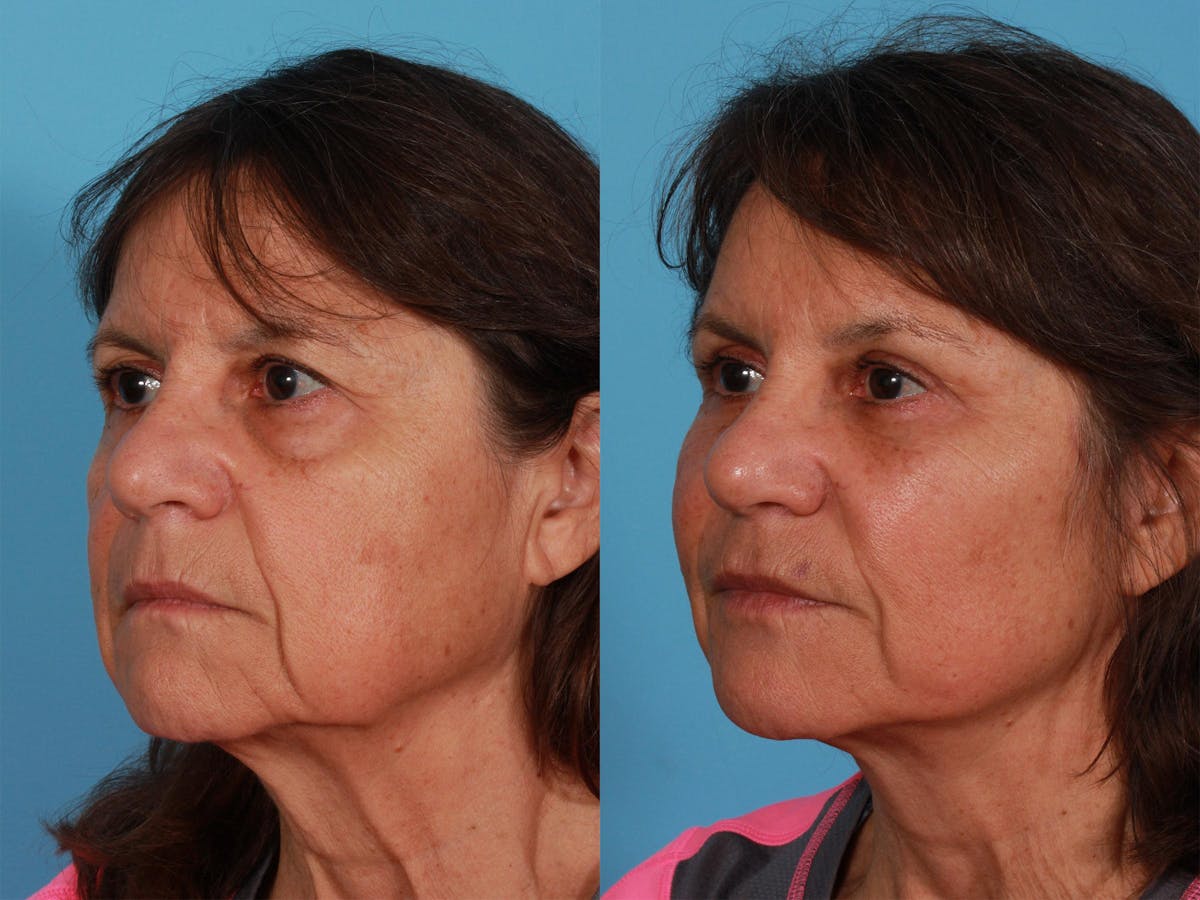 Limited Incision Facelift Before & After Gallery - Patient 347330 - Image 3