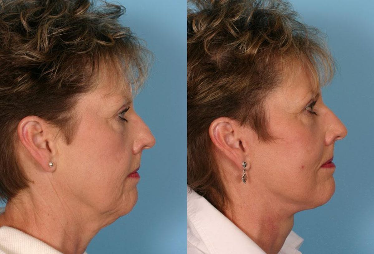 Facelift Before & After Gallery - Patient 329344 - Image 3