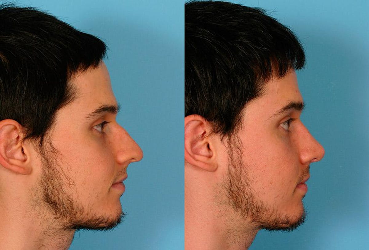 Nasal Obstruction Before & After Gallery - Patient 290720 - Image 2