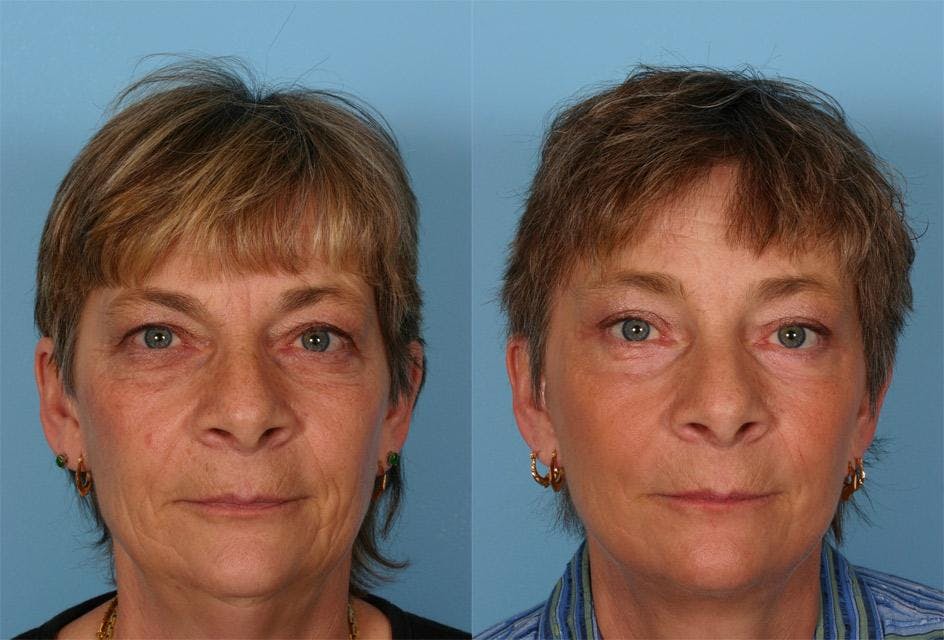 Facelift Before & After Gallery - Patient 199861 - Image 1