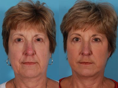 Limited Incision Facelift Before & After Gallery - Patient 269231 - Image 1