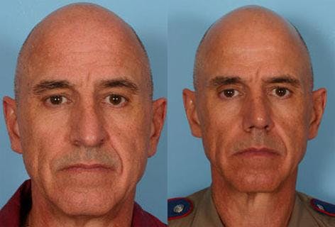 Rhinoplasty Before & After Gallery - Patient 421070 - Image 1