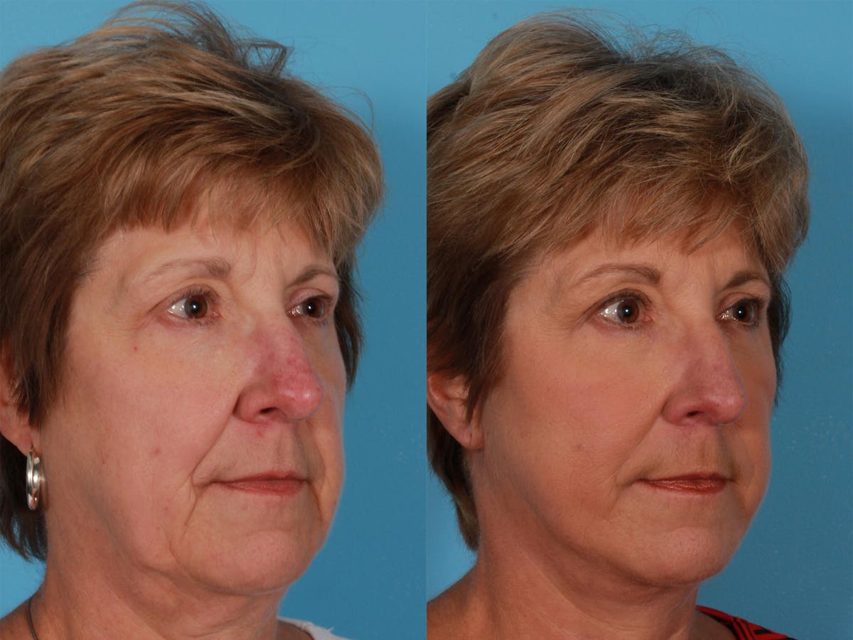 Limited Incision Facelift Before & After Gallery - Patient 269231 - Image 2
