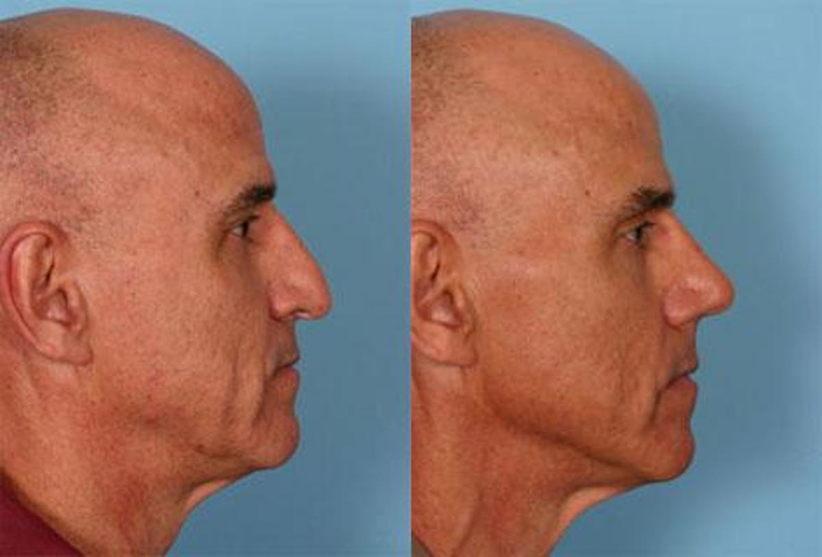 Rhinoplasty Before & After Gallery - Patient 421070 - Image 2