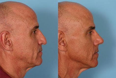 Rhinoplasty Before & After Gallery - Patient 421070 - Image 2