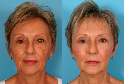 Facial Fat Transfer Before & After Gallery - Patient 352459 - Image 1