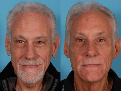 Endoscoplic Browlift Before & After Gallery - Patient 216186 - Image 1