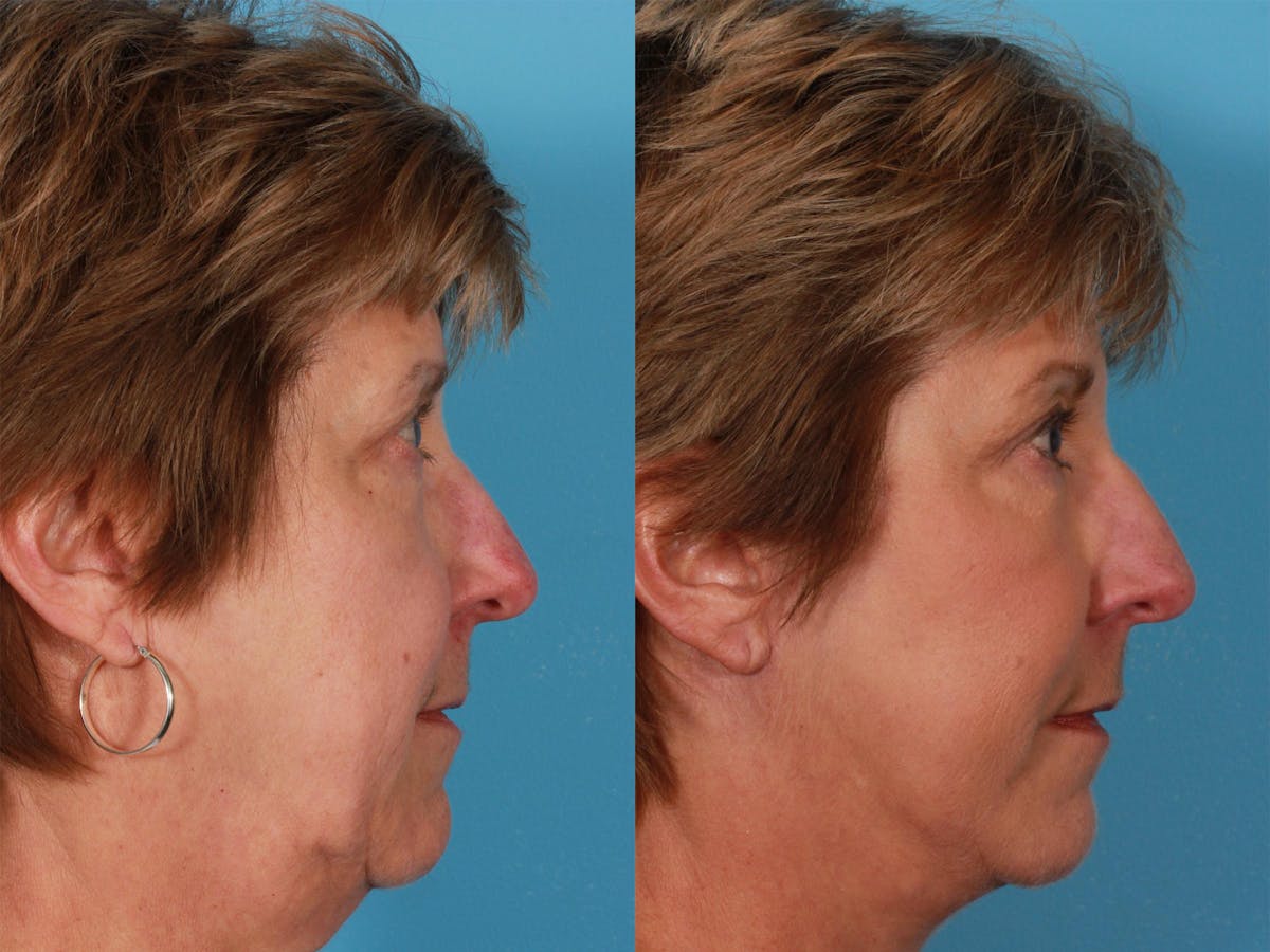 Limited Incision Facelift Before & After Gallery - Patient 269231 - Image 3