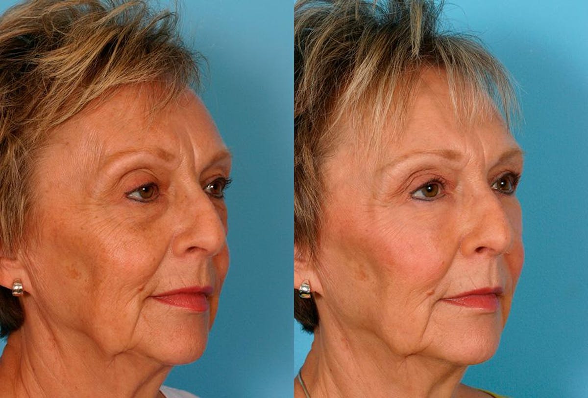Facial Fat Transfer Before & After Gallery - Patient 352459 - Image 2