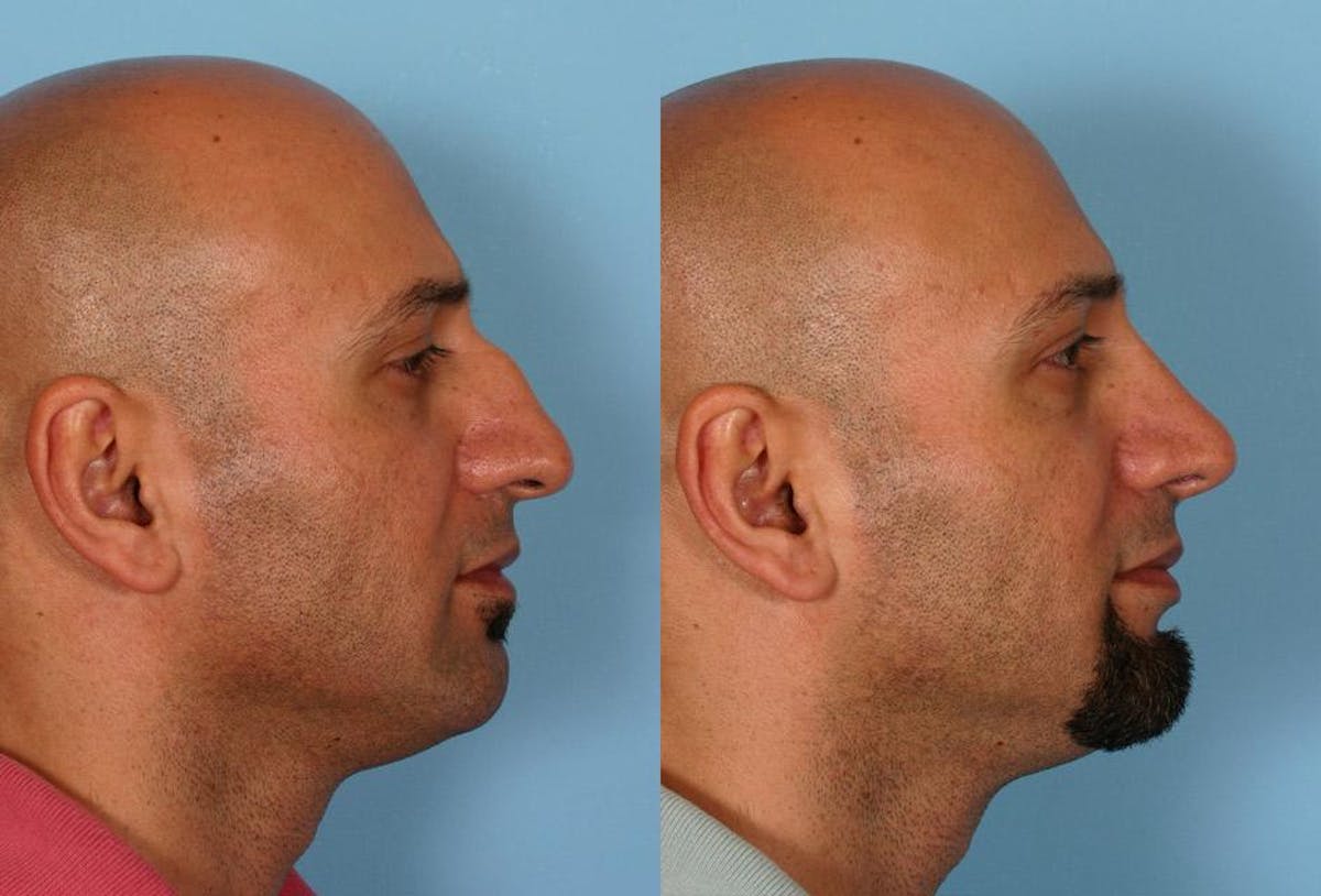 Nasal Obstruction Before & After Gallery - Patient 951222 - Image 2