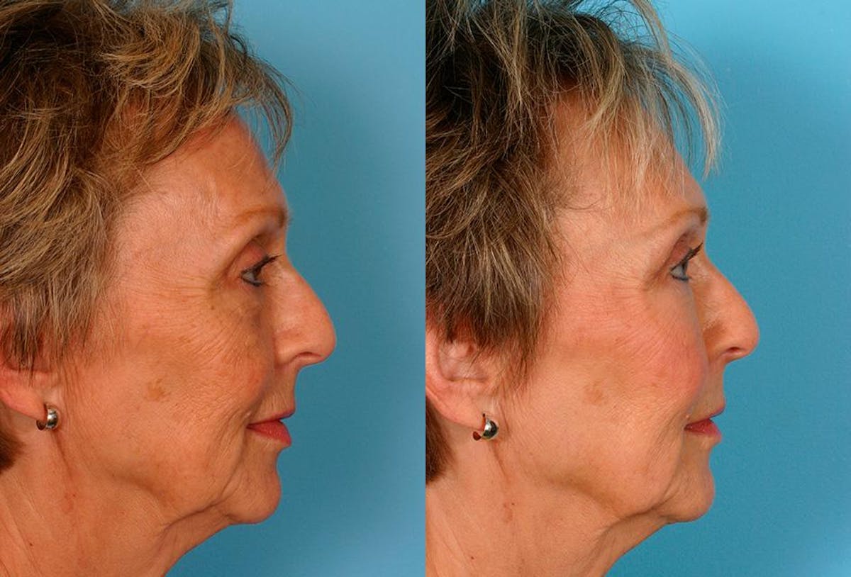 Facial Fat Transfer Before & After Gallery - Patient 352459 - Image 3