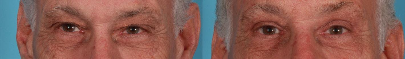 Endoscopic Brow Lift Before & After Gallery - Patient 216186 - Image 2