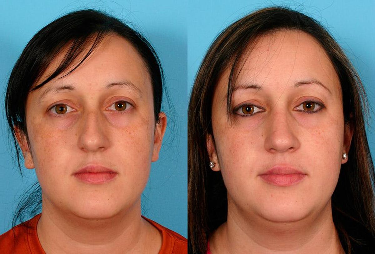 Rhinoplasty Before & After Gallery - Patient 415648 - Image 1
