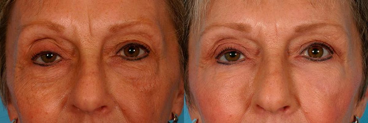 Facial Fat Transfer Before & After Gallery - Patient 352459 - Image 4