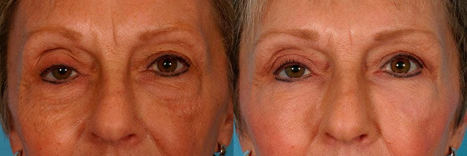 Facial Fat Transfer Before & After Gallery - Patient 352459 - Image 4