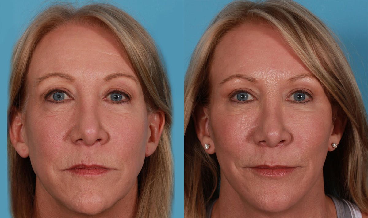 Limited Incision Facelift Before & After Gallery - Patient 228270 - Image 1