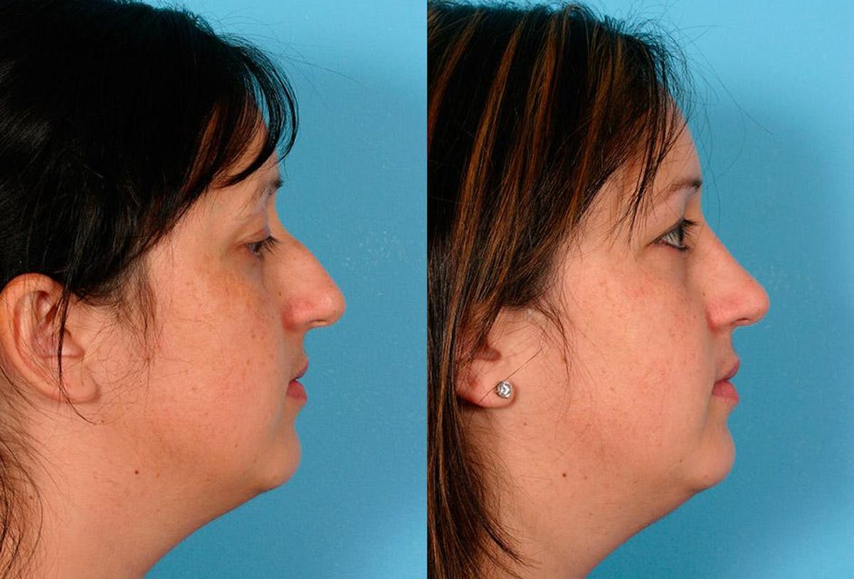 Rhinoplasty Before & After Gallery - Patient 415648 - Image 2