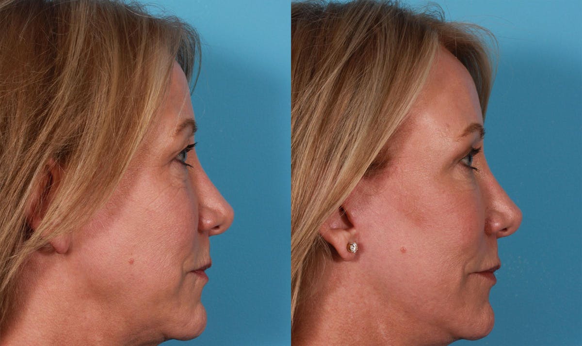 Limited Incision Facelift Before & After Gallery - Patient 228270 - Image 2