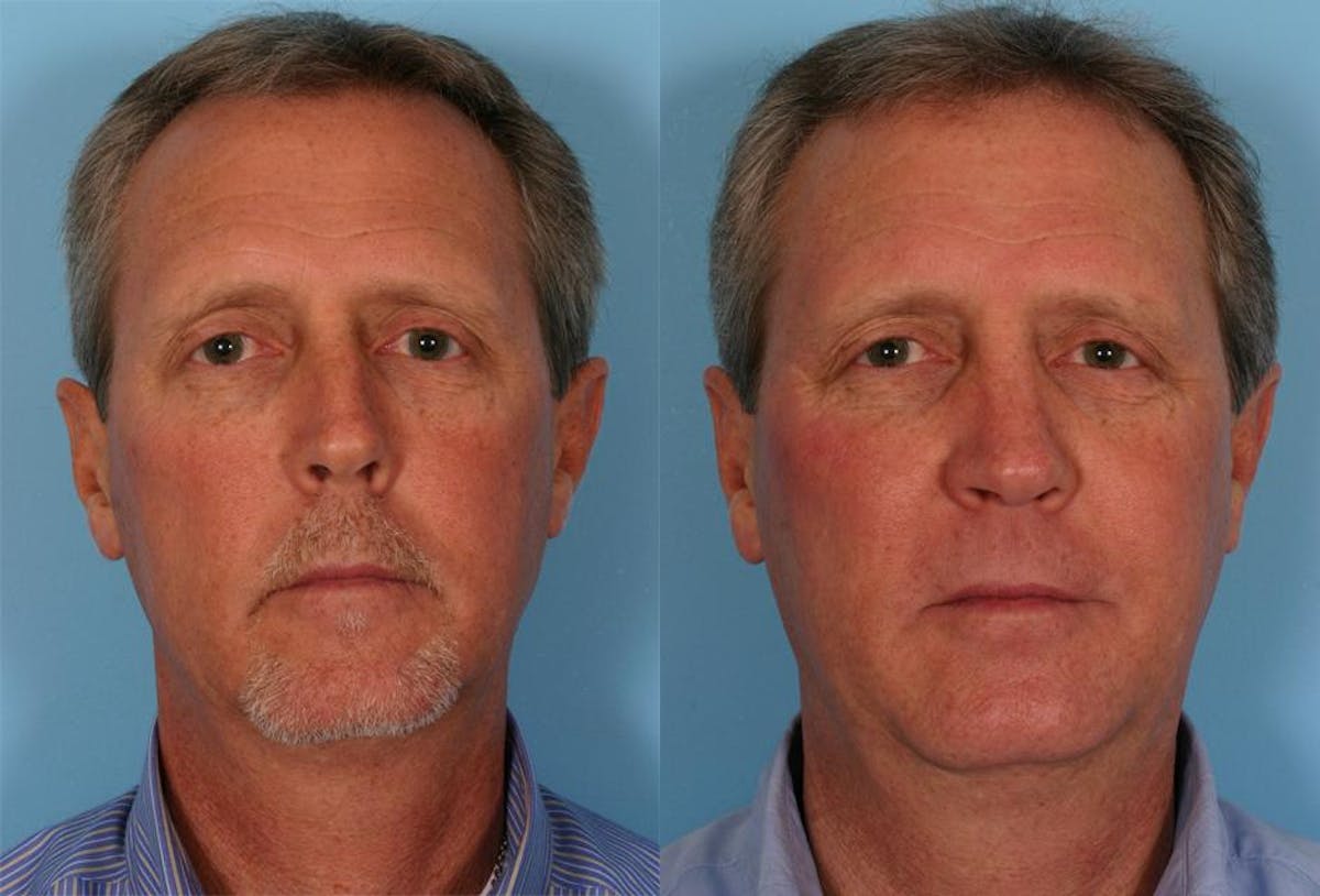 Rhinoplasty Before & After Gallery - Patient 595057 - Image 1