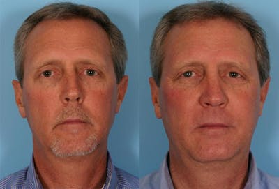 Rhinoplasty Before & After Gallery - Patient 595057 - Image 1